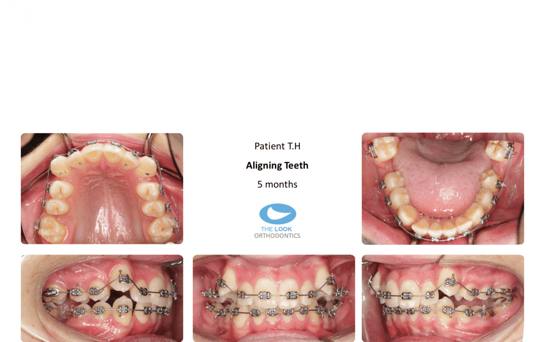 Dental crowding, bad Teeth > Treated with extractions & braces